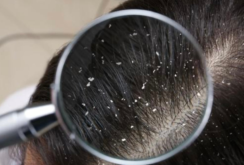 Anti-dandruff shampoo