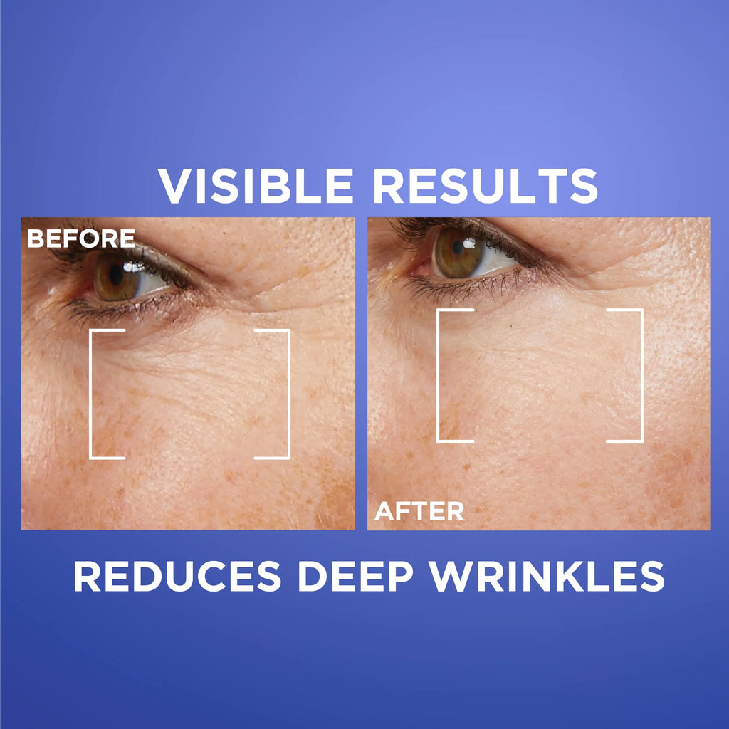 L'Oréal Paris Revitalift Laser Retinol Deep Wrinkle Night Serum, With 0.2% Pure Retinol and Vitamin A