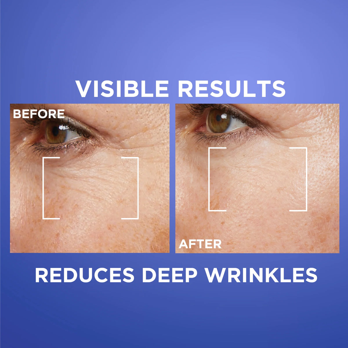 L'Oréal Paris Revitalift Laser Retinol Deep Wrinkle Night Serum, With 0.2% Pure Retinol and Vitamin A